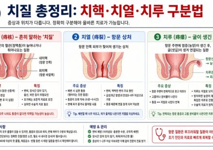 치질 총정리: 치핵·치열·치루 구분법